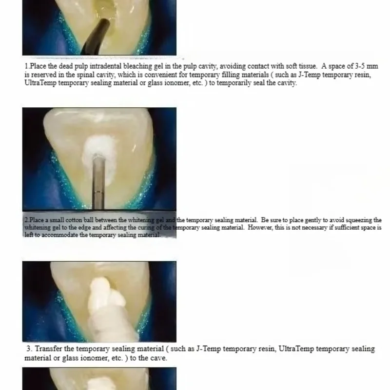 歯科口腔修復材料 死んだ歯髄の歯の漂白剤 漂白効果 色素を分 - Teeth Whitening Effects のレビューと価格