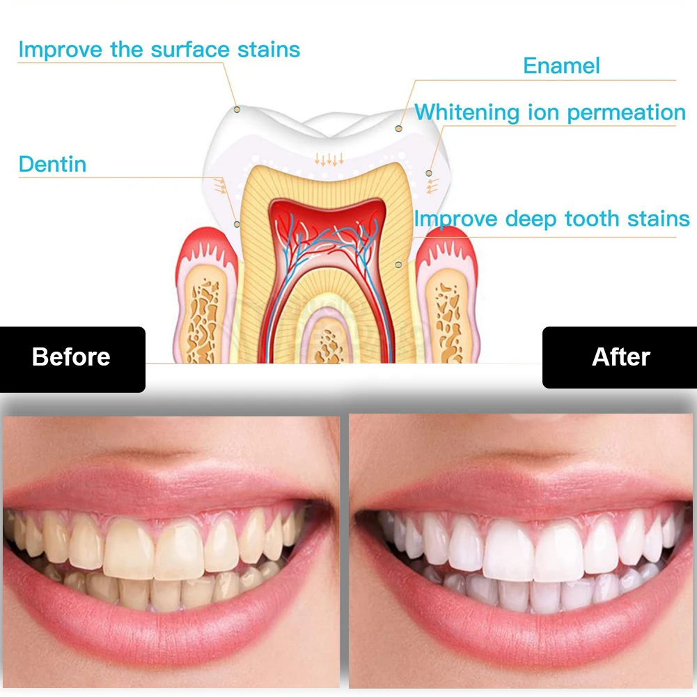 歯科歯ホワイトニングキットミニ 16 LED コールドライト - Teeth Whitening Price のレビューと価格